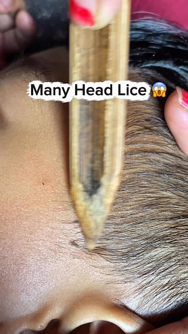 There are lots of head Lice causing itching 😱 #lice #headlice #kutu #kuturambut #sidup #suddup