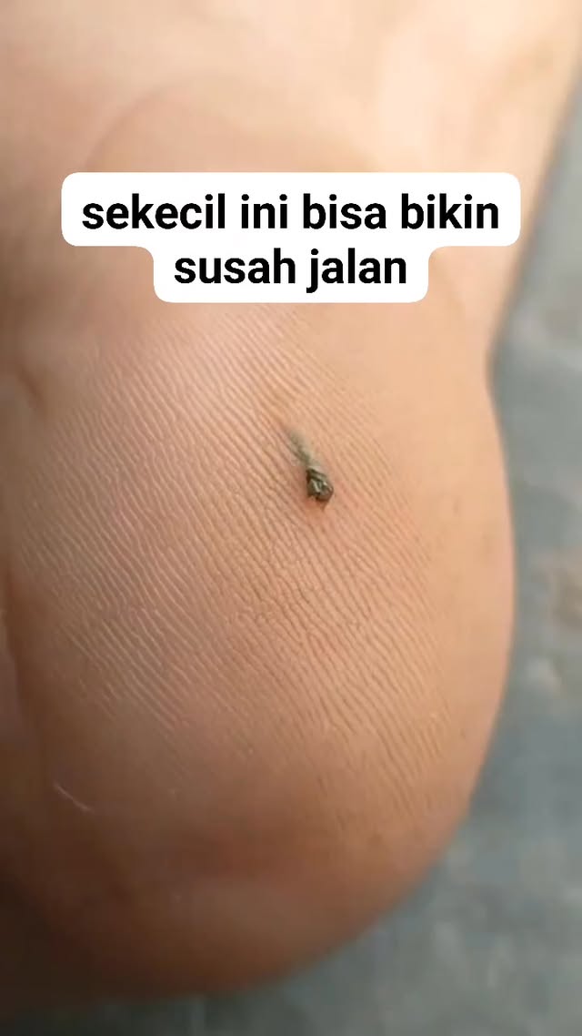 duri sekecil ini membuat kaki pinc4ng😱 #fyp #videoviral