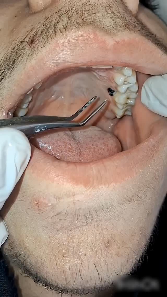 Deep Teeth Cleaning and Plaque Removal ​#igreach #explore #feed #igtrens #smilerestore