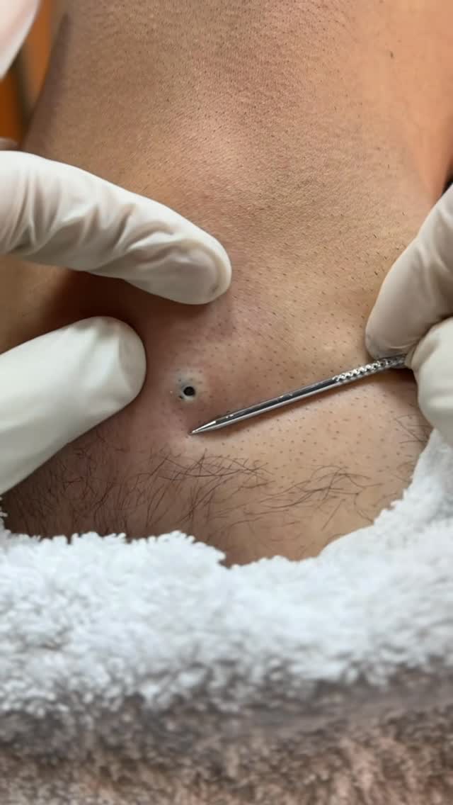 Black heads Removed #