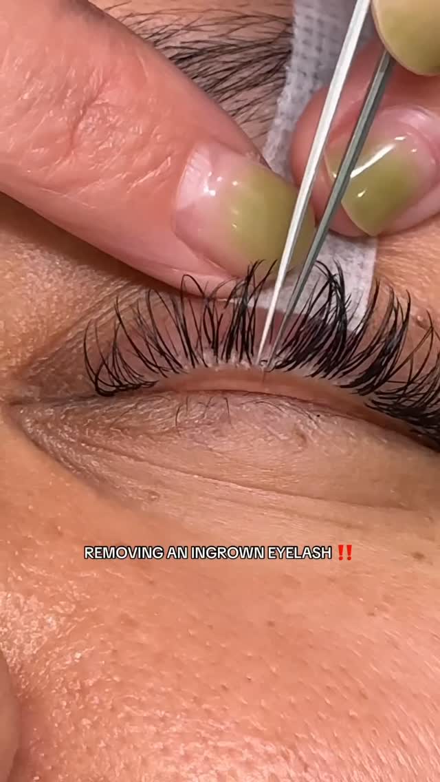 One year of this ingrown nail color controversy 😅💅🏼 45million on TikTok @deltalash #ingrownhair #las…