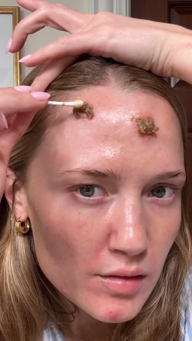 these big boys are angry!!!! #cysticacne #acnetreatment #nightroutine #acnejourney #acneskincare