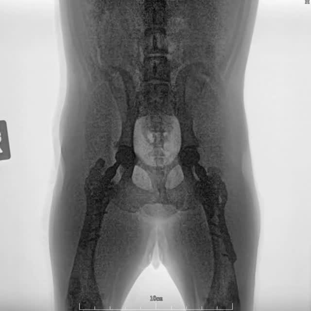 That moment when you realize you did everything right. 6 months after right joint replacement and 2 …