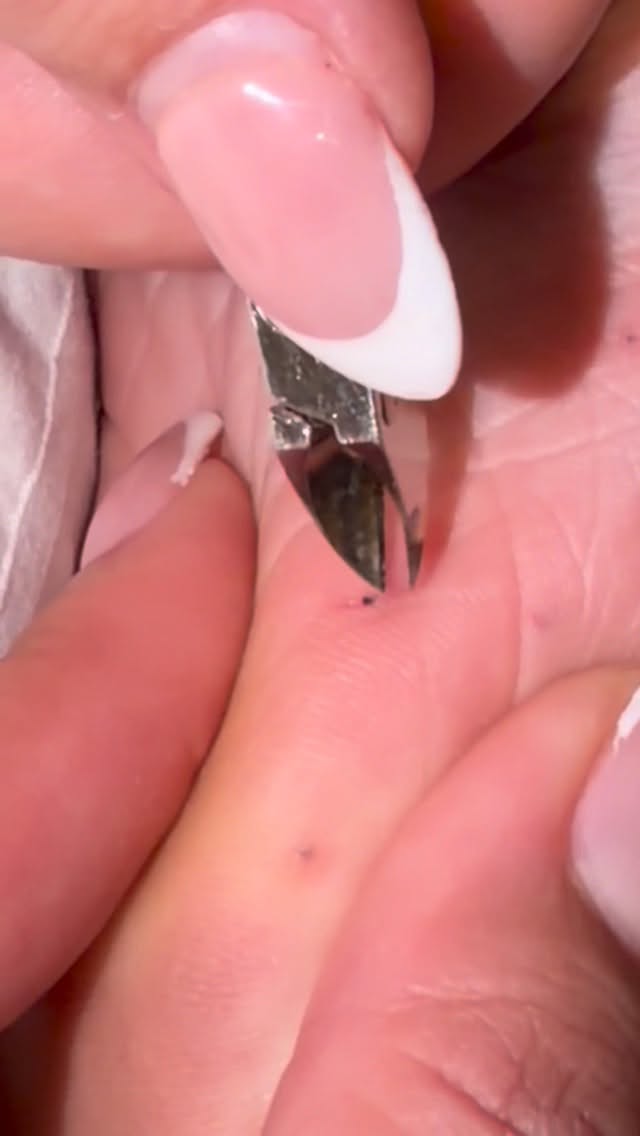 I asked my nail tech cousin to remove a sea urchin from my foot… this is how it went 🫪 @shakaya.yarr…