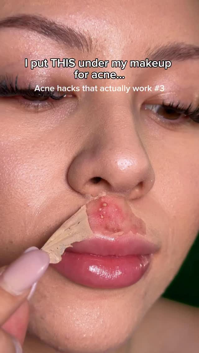 What do you think?😭 #acneproneskin #makeup #makeuphacks #pimple #beauty